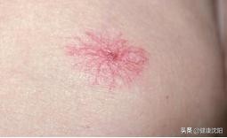 全国爱肝日肝病临床试验报告,全国爱肝日携手消除肝炎危害