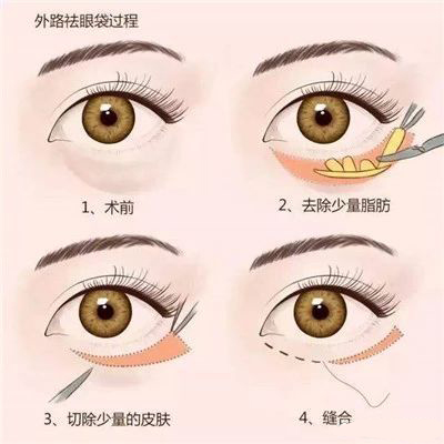 去眼袋整形失败案例,科普整形科去眼袋