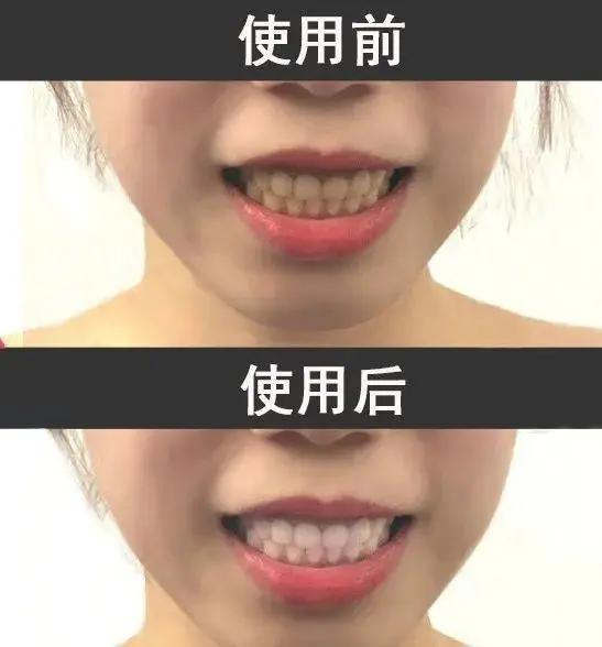 儿童敏感牙齿专用牙膏,敏感牙齿用什么牙膏儿童