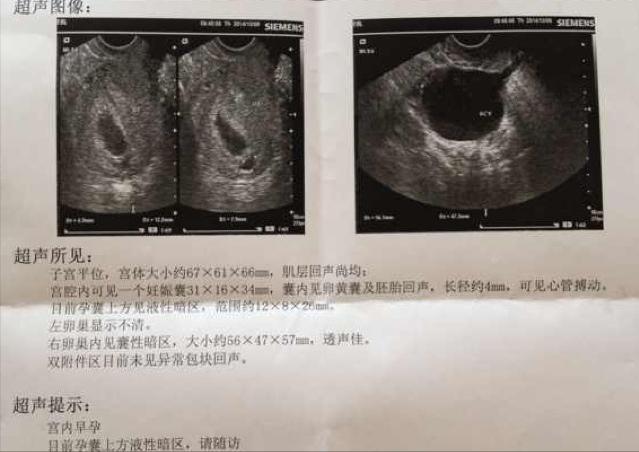 怀孕一般几周能够看到孕囊,孕囊大小判断大孕囊还是小孕囊