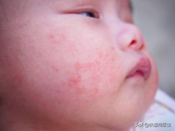 湿疹用的激素类药物,宝宝湿疹能用激素类药物吗