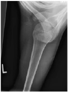 浏阳骨伤科医院髋关节脱位,肩锁关节脱位看骨伤科吗