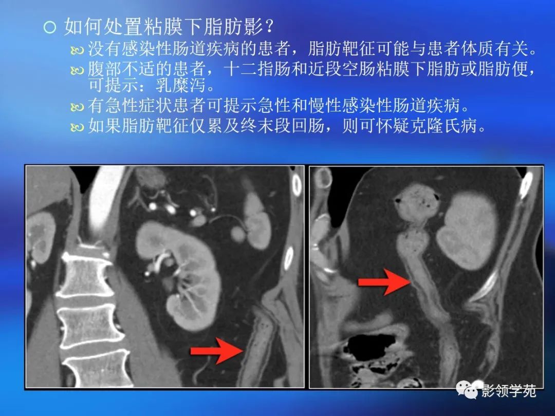 肠道内壁增厚,肠道扩张ct表现