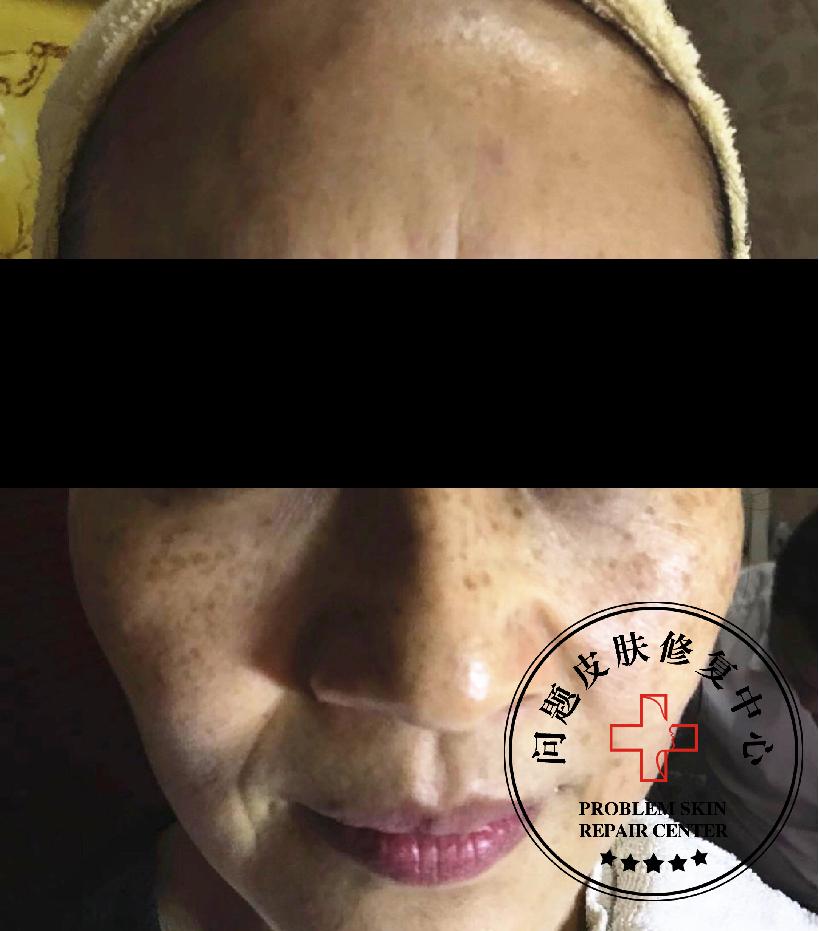 激光反黑怎么快速修复,点阵激光反黑了怎么修复