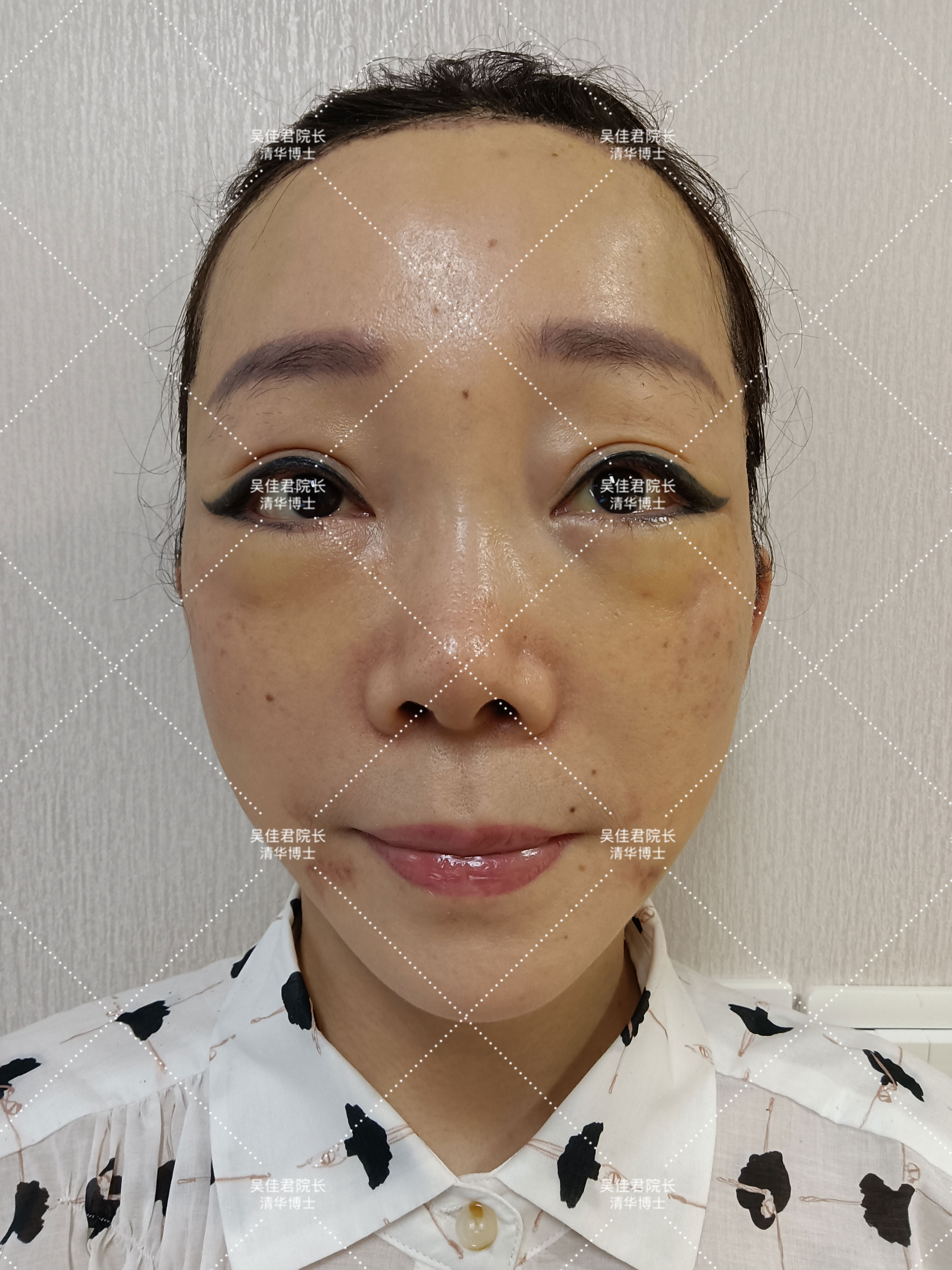 小切口拉皮除皱术合适额头除皱吗,额头缩小大拉皮手术恢复过程