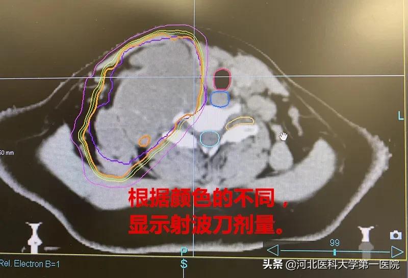 神奇魔法刀，一点就消！点亮肿瘤绝境患者，再生的希望之光