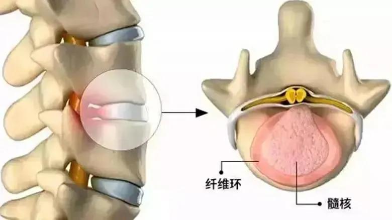 腰疼腿不疼会是椎间盘突出吗,椎间盘突出引起的腰痛怎么治
