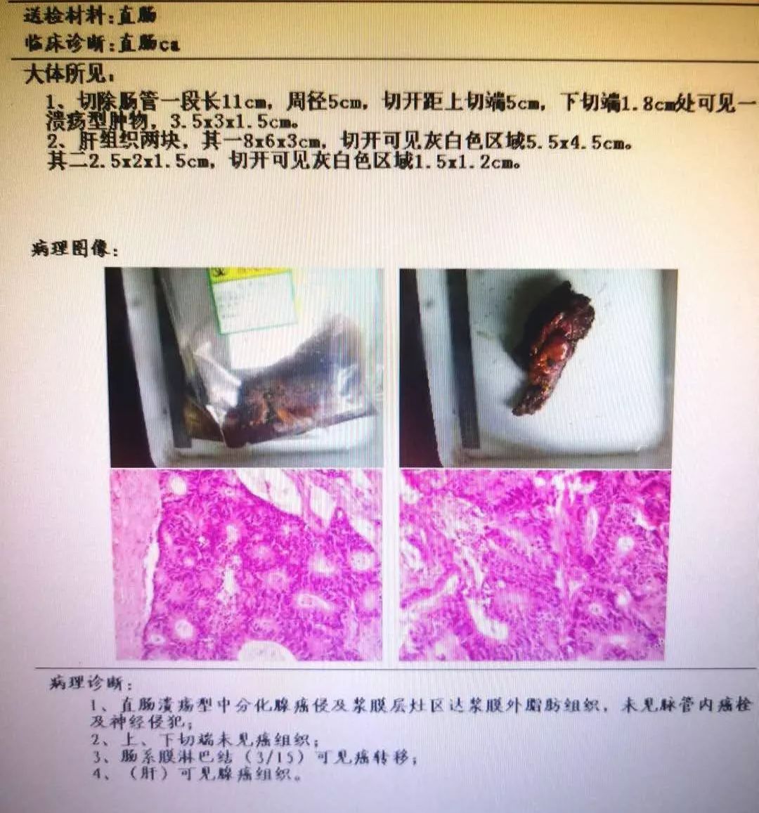 县中医院首例腹腔镜手术圆满告捷,直肠癌腹腔镜手术告捷案例