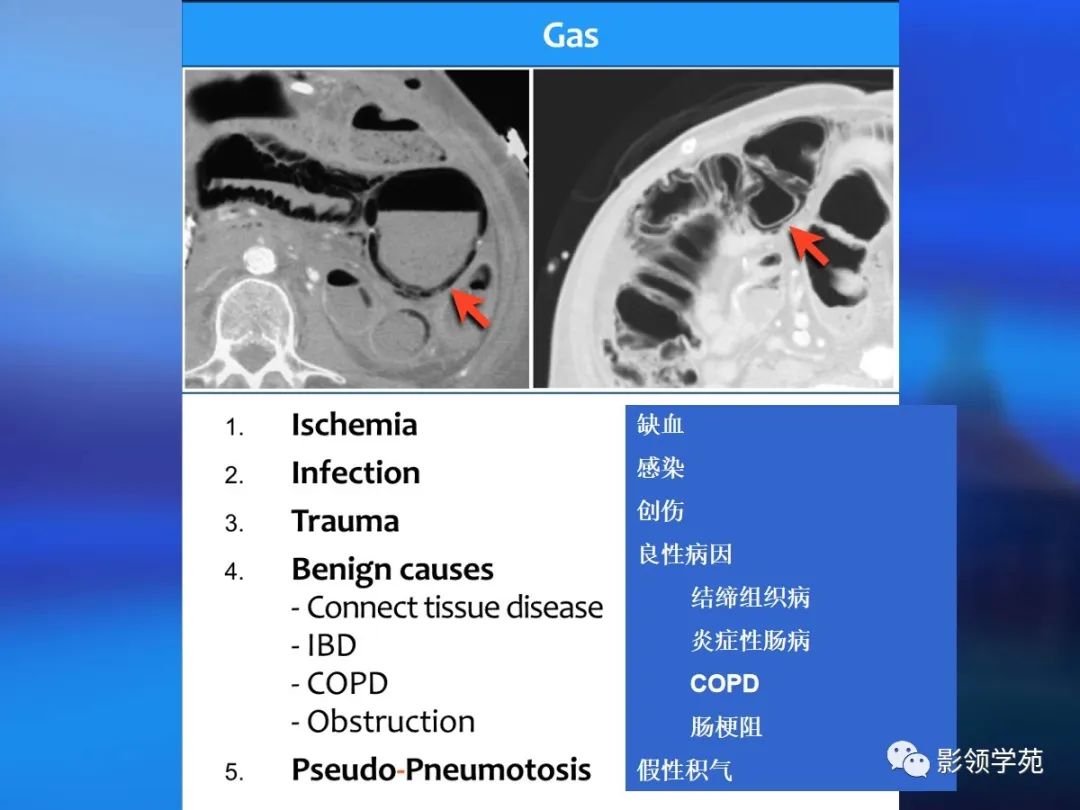 肠道内壁增厚,肠道扩张ct表现