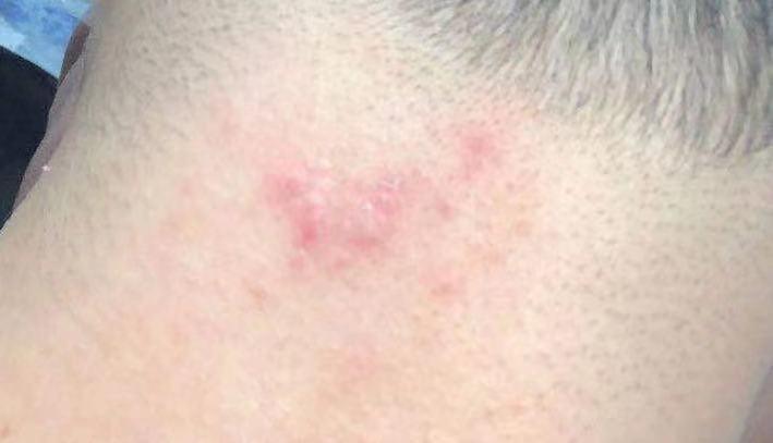 针眼、跖疣、毛囊炎，化脓了怎么办？千万别挤