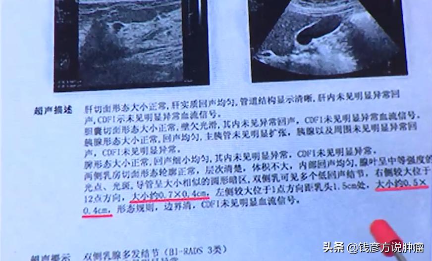 子宫肌瘤结节怎么治疗效果好,45周岁子宫肌瘤乳腺结节三级