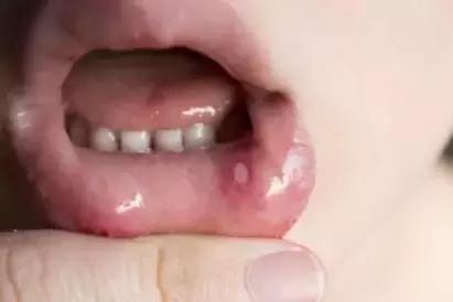 小孩鹅口疮和口腔溃疡的区别,鹅口疮跟口腔溃疡怎么区分