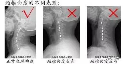查出颈椎多节病变,颈椎生理曲度稍变直能恢复吗