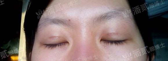原来双眼皮不好看有必要继续割吗,割双眼皮是不是越修复越难看