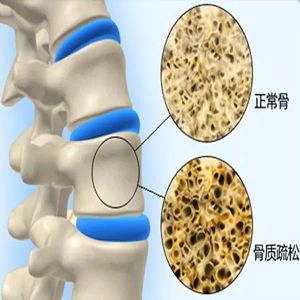 缺钙自测100题,缺钙评估