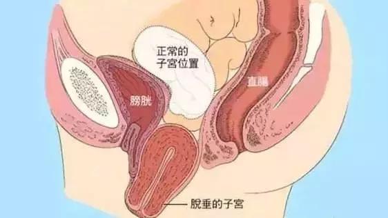 阴道里脱出块“肉”！