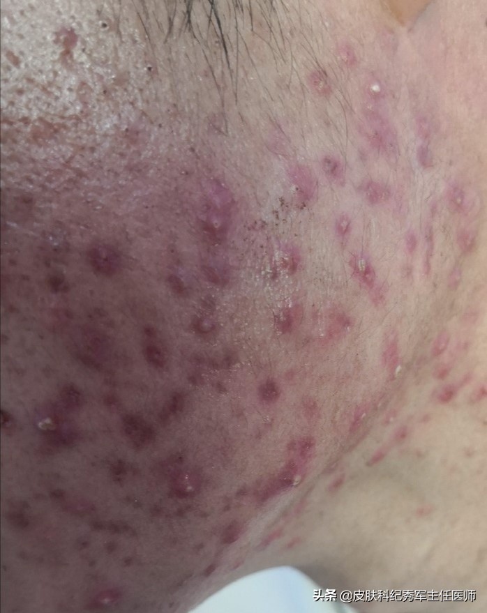 喜辽妥软膏能够祛除红色痘印吗,疤克能够去除脸上的红色痘印吗