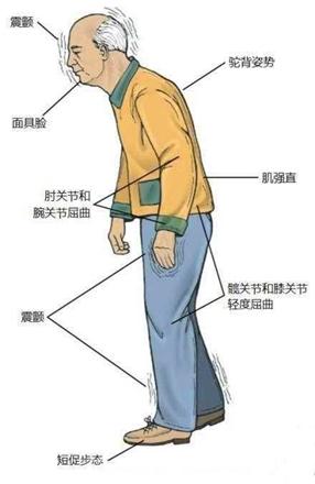 几个动作自测有无患帕金森病迹象,9个问题测试帕金森风险
