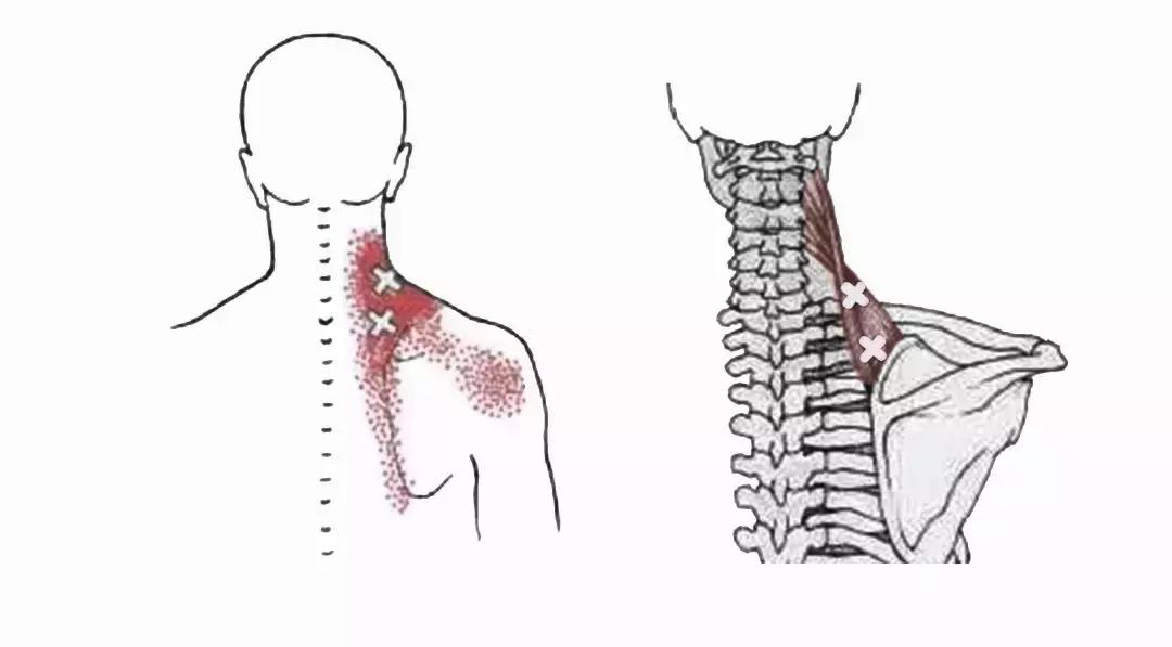 颈椎腰腿痛针刀,针刀颈椎病