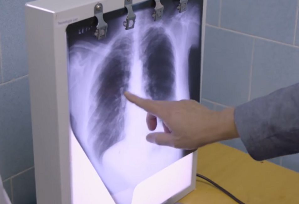 新型肺癌疫苗有望攻克,对抗癌症的疫苗