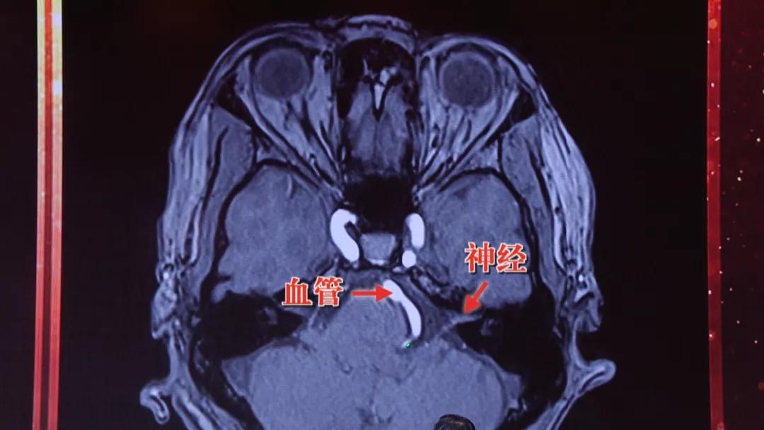 眼皮跳财运到？当心是一种特殊高血压！行家：用一块棉垫就能治愈