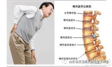 腰椎间盘突出怎么治疗好得快,我家祖传治疗腰椎间盘突出的秘方