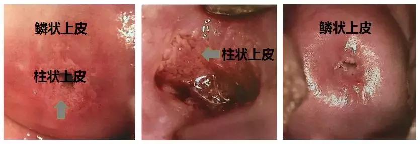 宫颈糜烂肥大囊肿会引起宫颈癌吗,宫颈肥大宫颈糜烂宫颈囊肿症状