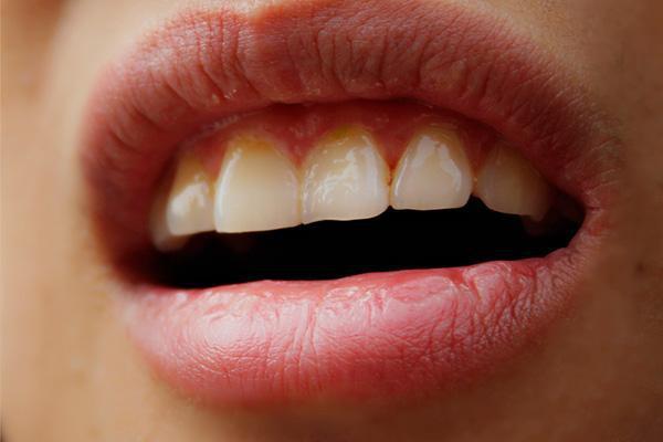 长期使用漱口水会有什么后果,漱口水是否能够频繁使用