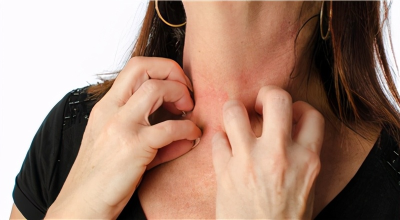 怎么减少挠痒的痒感,夏季过敏性皮炎痒了能挠吗