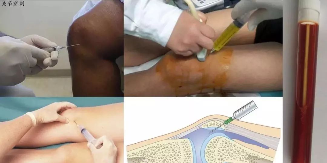 滑膜炎积液骨科医生怎么治,骨科行家滑膜炎是什么症状