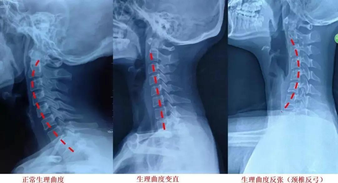 颈椎曲度变直正骨复位视频,颈椎曲度变直正确睡姿图片
