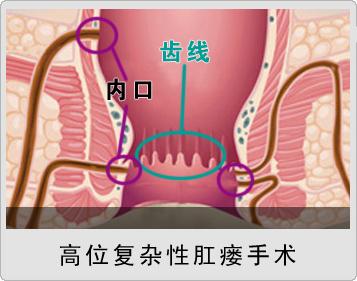 大便粘马桶肛门潮湿有分泌物,肛门周围有小颗粒潮湿痒分泌物