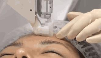 靠“副功能”上位的美白新贵——氨甲环酸到底有多神奇