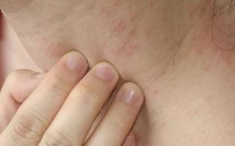 夏天出了很多痱子用藿香正气水,夏天食欲不好藿香正气水有用吗