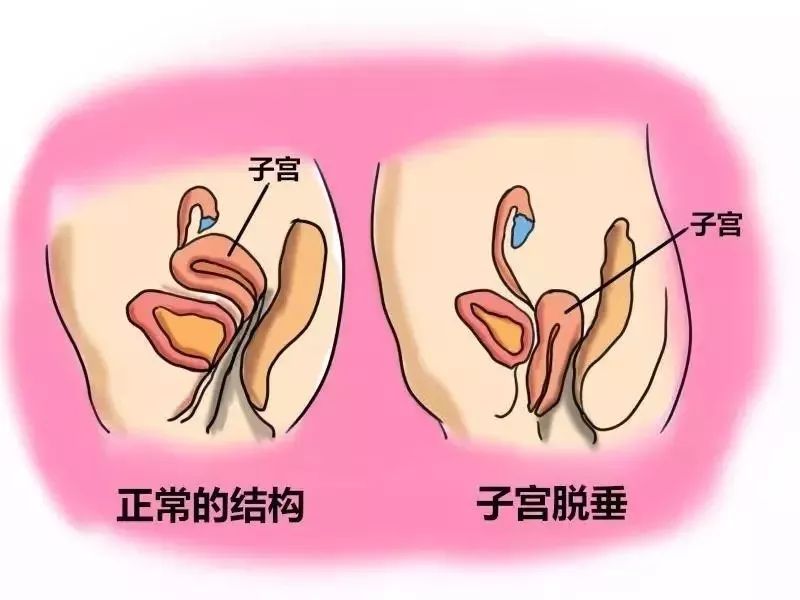 七旬老妪的难言之隐，其实能够这样预防