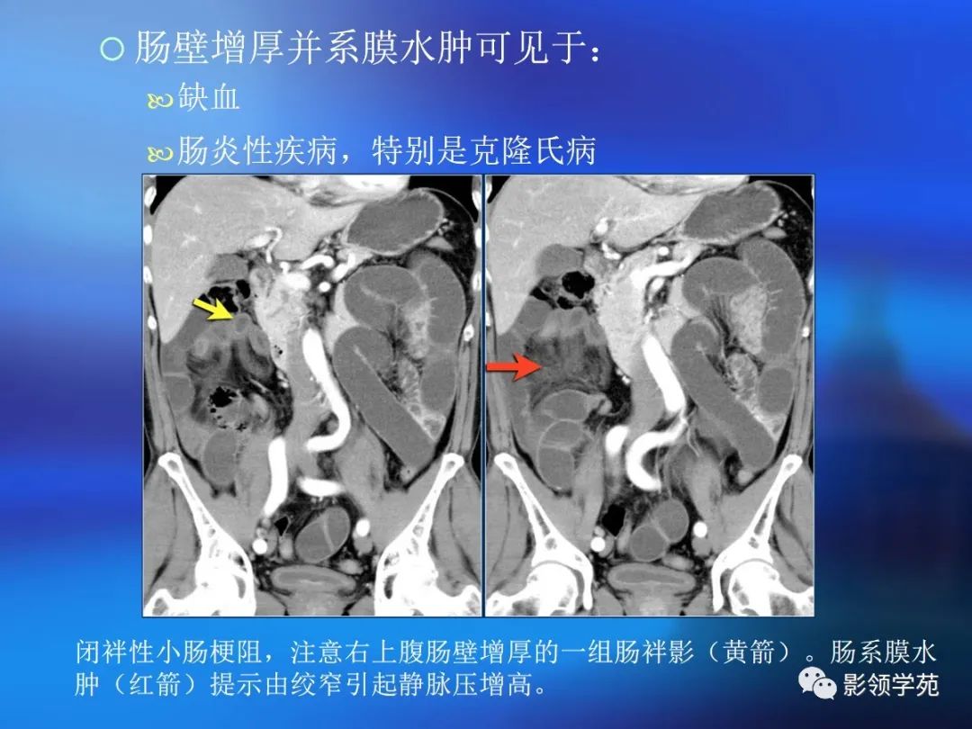 肠道内壁增厚,肠道扩张ct表现
