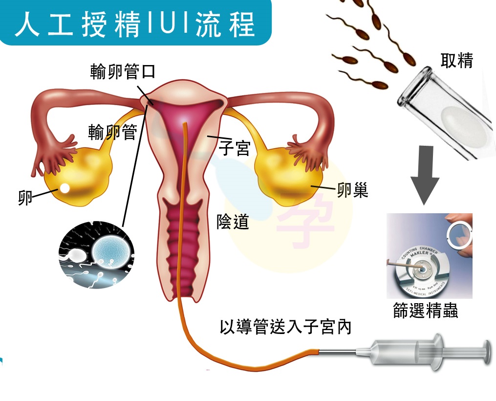 看呆医生：一次告捷！医院人工授精太贵，英女子购买针筒自行操作