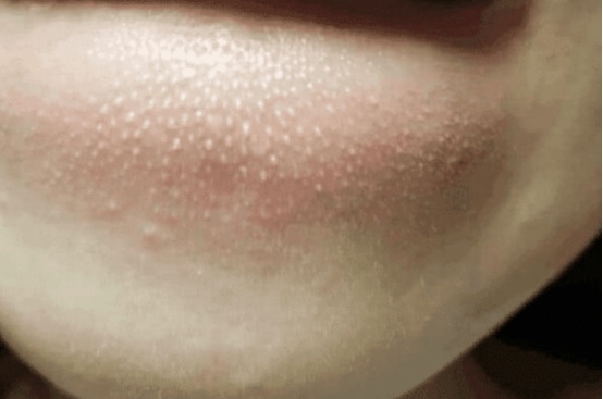 抿嘴上嘴唇很多白色颗粒怎么消除,抿嘴时下嘴有小颗粒是怎么回事