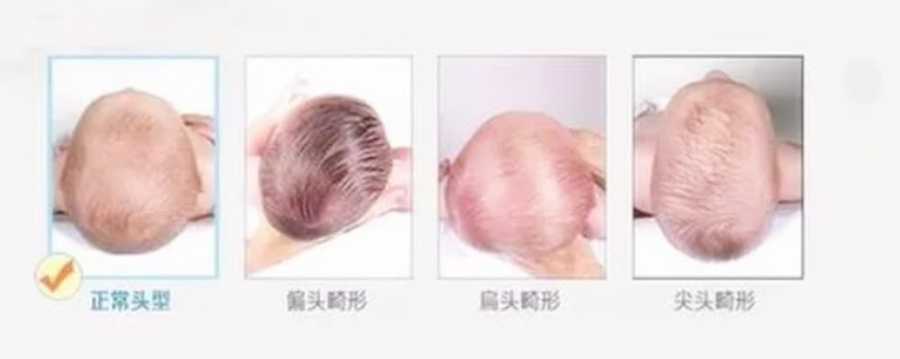 孩子头型偏了是不是扎辫子都不正,5个月宝宝头型不正还能够纠正吗