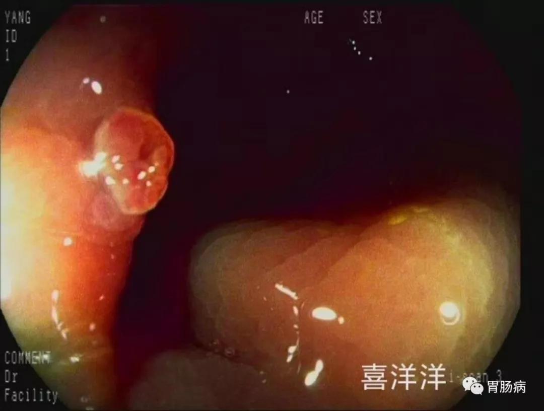 胆囊息肉19mmx10mm会变成癌不,息肉增生会不会变癌
