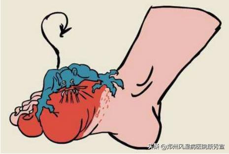 痛风发作怎么能够快速缓解,痛风突然发作怎么样能够马上止痛