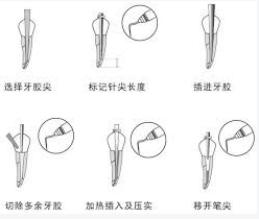 做了根管充填术下一个流程是什么,根管充填详细流程视频