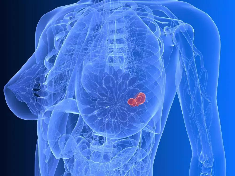 乳腺囊肿or乳腺结节傻傻分不清，一篇文章给你答案