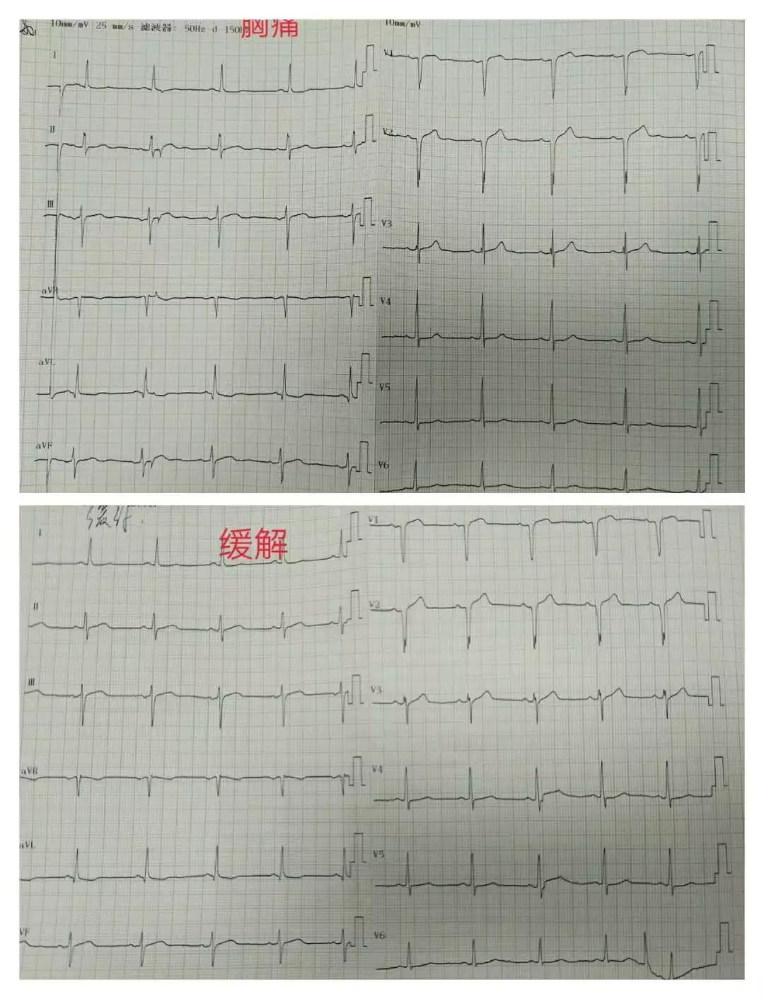 胸痛吃硝酸甘油缓解是怎么回事,发生胸痛为什么慎用硝酸甘油