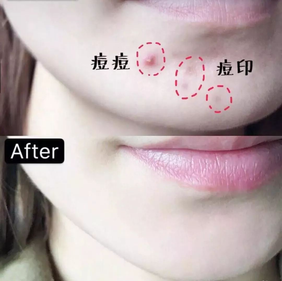 红肿，流脓的万年毒痘一喷全消失？岛国新晋痘肌终结者！彻底祛痘不反复！