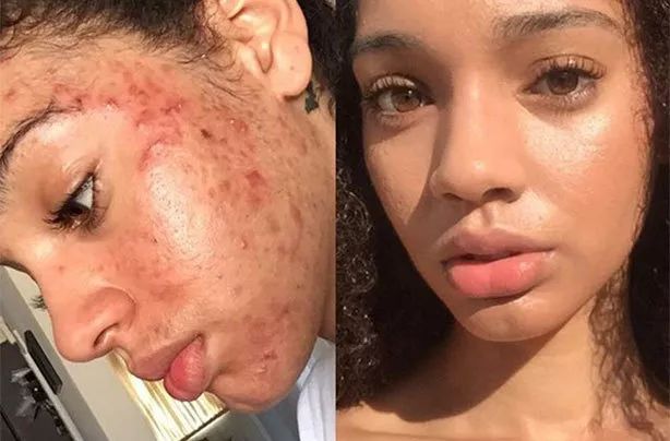 脚气湿疹止痒最快的软膏,湿疹止痒膏能够治脚气吗