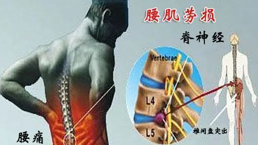 腰肌劳损如何缓解和治疗,腰肌劳损怎么自己缓解