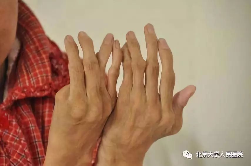 预告｜类风湿关节炎，预防控制至关重要！北京大学人民医院栗占国做客BTV《健康北京》