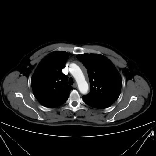 胸痛有时还会伴有响声,胸痛并伴有咽喉有异物感