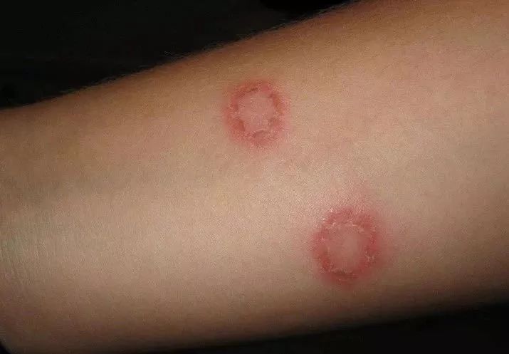 猫癣传染给人怎么办能治愈吗,猫癣给人传染了怎么办